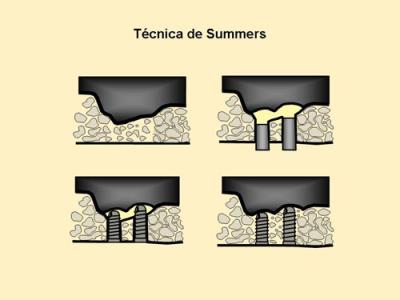 técnica de summers